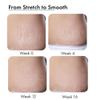TH.R.I.V.E Stretch Marks Expert Serum Cream | For New(Red) & Old (White) Stretch Marks Removal & Skin Hydration, Rosehip Oil & Squalane For Men & Women, 30ml view 4