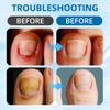 Ingrown Toenail Corrector, 2025 New Professional Ingrown Toenail Tool Kit with Toenail Strips, Curved Toenails Corrector Patch, Painless File and Lifter Pedicure Tools (3 Set) view 2