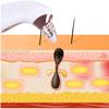 EZAGMWGFB Blackhead Removal Pore Vacuum, Cold Compress, Acne Comedone Whitehead Remover view 3