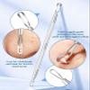 3PCS Pimple Extractor Acne Treatment Tool Professional Stainless Blackhead Comedone Removal Popper Tool for Face Nose Blackhead Extractor Tool (Silver) view 2