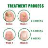 Nail Fungus Treatment Gel  Multi-Purpose Nail Repair, Nail Growth Serum for Repair (1) view 3