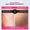 Thrive..Co. Stretch Marks Expert Serum Cream | For New (red) & Old (white) Stretch Marks Removal & Skin Hydration | Powered by Striover, Rosehip Oil & Squalane | For Men & Women | 30ml view 3