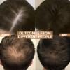 2026 Upgrade Wireless Laser Cap for Hair Regrowth, Red Light Therapy for Hair Growth view 4