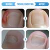 Professional Ingrown Nail Corrector Set, 2025 New Ingrown Toenail Removal Kit Includes Breathable Ingrown Toenail Strips, Corrector Patch, Pedicure Tools, Ingrown Nail Tool for Women Men (Style-A) view 2