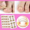 Ingrown Toenail Corrector Set with Correction Strips,Curved Toenails Corrector Patch, Painless File and Lifter Pedicure Tools for Women Man view 3