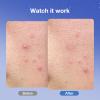 arvyne Overnight Pimple Patches 1.5X Thicker Hydrocolloid Acne Zit Patches for Face, All-Night Adhesion, Max Absorbency, Easy-Peel Design, Skin-Friendly, Korean Skin Care, 2 Size 36 Count view 4