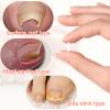 (50+1) Pcs Ingrown Toenail Treatment Corrector Set, Professional Pain-Free Ingrowns Toenails Removal Kit with Lifter, Toenail Strip for Men Women, Easy Fixed Ingrowns Toenails Tool view 4