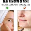 50 Pcs Professional Disposable Pimple Needles Acne Needle, Blackhead and Blemish Remover Tools view 3