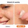 TKTK Pimple Patches for Face, 0.01cm Ultra-Thin Invisible Acne Patches, Hydrocolloid Patches for Breakouts, Absorbs Zits & Blemish, Suitable Under Makeup, 2 Sizes(10mm/12mm) 168 count view 3