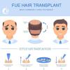 FUE Hair Follicle Extractor for Seamless Hair Transplant, Eyebrow & Beard Restoration, Advanced Hair Loss Treatment for Men & Women, Boost Hair Growth & Confidence view 4