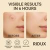 Pimple Patch  The Discreet and Effective Daytime hydrocolloid Acne Patch for pimples and Blemishes. Tapered Edges Designed to Blend into The Skin (36 Units) view 4