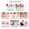 Multifunctional Skin Blemish Removal, Pigmentation Removal, and Skin Smoothing Tool, Professional Hair Removal Device view 4