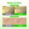 Acropass Microcone Pimple Patch Blemish Care - Post-Blemish, Redness, Dark Spot, Niacinamide, Dermatologist Tested, Non-Irritating, Cruelty Free (8 Count) view 3