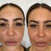 TC 30% Gel Peel, Chemical Peel for Face Breakout Scars, Chemical Exfoliant for Face, Strength Level 2, 1.0 fl oz. e, 30 mL  Kiaeva Cosmetics (30) view 2