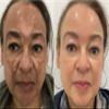 TC 30% Gel Peel, Chemical Peel for Face Breakout Scars, Chemical Exfoliant for Face, Strength Level 2, 1.0 fl oz. e, 30 mL  Kiaeva Cosmetics (30) view 3