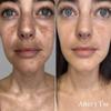 TC 30% Gel Peel, Chemical Peel for Face Breakout Scars, Chemical Exfoliant for Face, Strength Level 2, 1.0 fl oz. e, 30 mL  Kiaeva Cosmetics (30) view 4