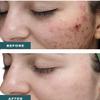 TC 25% Gel Peel, Chemical Peel for Face Breakout Scars, Chemical Exfoliant for Face, Strength Level 2, 1.0 fl oz. e, 30 mL  Kiaeva Cosmetics (25) view 4