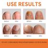 Bee Venom Spray, Advanced Bee Venom Toenail Repair Spray - Nail Treatment for Damaged Nails, Soothing, Nourishing & Moisturizing Formula, Safe & Gentle Nail Care Solution (1PCS) view 2