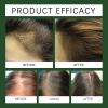 | Biotin | Hair Growth Supplement | Skin Care | Rosemary Hair Growth Essential Oil Promotes Healthy and Nourishing Hair Growth, Tough Hair Essential Oil Hair (3.38 Fl Oz) view 2