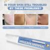14% Azelaic Acid Soothing Cream 30g - Facial Serum with Niacinamide & Vitamin C for Acne Scars, Dark Spots, Balancing Sebum & Preventing Breakouts view 3