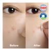 Cordiale Korean Pimple Patches for Face, Centella Acne Patches, 78 Count view 2