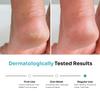 Foot Cream Roll On with 20% Urea, 2% Lactic Acid, Glycerine & Olive Oil for Dry Feet, Cracked Heels & Diabetic Foot | Non Sticky Formulation - 50ml view 3