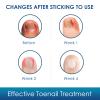 Ingrown Toenail Treatment, 50Pcs Breathable Ingrown Toenail Corrector Patches with Nail File & Lifter, Professional-Grade Treatment for Fast Results view 4