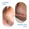 20% Urea Foot Cream Roll On 50ml | For Dry & Cracked Heels | With 2% Lactic Acid, Olive Oil & Vitamin E | Helps Repair and Moisturise Cracked Heels(Be Bodywise) view 4