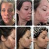 Jessner's at home Chemical Peel Solution 20% Gel Peel, for Face Breakout Scars, Chemical Exfoliant for Face, Strength Level 2, 1.0 fl oz. e, 30 mL  BUY1GET1FREE view 2