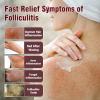 LMNOOP Folliculitis Treatment Cream, 3.52oz view 3