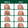 VERDORA FIXLAB Nail Patches Extra Strength with Tea Tree Oil 16 Pcs view 3