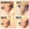 BANATU 60Pcs Silicone Healing Pull Piercing Discs for Piercing Bump 3/5/7/9mm Clear Disc Pads Earlobe Patches view 3