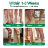 Vein Target Microdarts Patch, 2026 New Leg Varicose Veins Patchs, Vein Target Patch, Relieves Leg Discomfort, Moisturizes And Smooths Skin. (4PCS) view 2