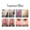 Facial Vein Treatment Device, Red Blood Removal Device, Easy Treatment, 4 Levels Intensity Adjustable, 0.03mm Needle Wire, Minimally Invasive and Painless, Safe and Reliable, for Home Beauty view 3