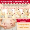 Stretch Mark Belly Butter for Pregnancy, Massages Maternity Body & Reduces Scar Appearance, Rich Hypoallergenic Moisturizing Organic Cocoa Butter & Coconut Body Butter for Women, 100g/3.53oz(2Pack) view 3