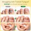 Toenail Fungus Treatment Extra Strength - with 25% Undecylenic Acid - SafeFight Nail Repair Solution for Damaged Nails, Ingrown Nails & Discoloration, 30ML view 2
