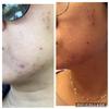 Skin Exfoliating Solution | Cosmetic Chemical Peel for Face (1oz/30ml) (50% Strength) view 2