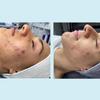 Skin Exfoliating Solution | Cosmetic Chemical Peel for Face (1oz/30ml) (50% Strength) view 3
