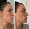 Skin Exfoliating Solution | Cosmetic Chemical Peel for Face (1oz/30ml) (15% Strength) view 4