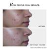 Noaology Acne Spot Corrector Gel | For Active Acne, Pimples, Whiteheads | 30g view 4