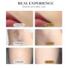 Hair Removal Machine with Ice Cooling Applicator hair reduction view 2