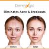 Acne Treatment Pads- Contains Salicylic, Glycolic, & Lactic Acid for Face & Body. Clears Away Clogged Pores, Oily Skin & Cystic Breakouts. Removes Dark Spots, Blackhead & Whitehead Pimples view 3