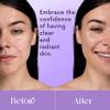 NXN Acne Edit Spot Treatment with Probiotics, Licorice Root, Ginger and Colloidal Sulfur, to rapidly reduce acne blemish size view 2