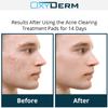 Acne Treatment Pads- Eliminates Pimple, Whitehead, blackhead, & Cystic Breakouts. Clear Clogged Pores, Oily Skin, Blemish, Dark Spots & Improve Skin Texture. 60 count view 3