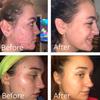 Dr Song Benzoyl Peroxide Wash 10% Acne Treatment: Acne Face Wash & Body Wash (8 Fl Oz (Pack of 1)) view 2