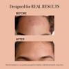 reVive Light Therapy Clinical Acne Treatment for Face, Blue Light Therapy Device view 3