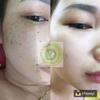 02 boxes *100ml - Sc Mc Lam  Php mu t thin nhin- C tho dc c tr mn- nm- tn nhang Sc Mc Lam- Natural herbal remedy dark acne skin, melasma - Ship from USA 7-14 days view 4