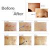 7pcs Stainless Blackhead Pimple Blemish Comedone Acne Extractor Remover Tool Set Kit view 4