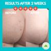 Butt Acne Clearing Lotion (2 pack) for back, buttocks, & thighs - Clears away acne breakouts and reveals new brighter skin view 2