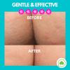 Butt Acne Clearing Lotion (2 pack) for back, buttocks, & thighs - Clears away acne breakouts and reveals new brighter skin view 4